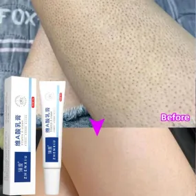 Body Whitening Cream Keratosis Pilaris Treatment Bumpy Rough Chicken Follicle Skin Repair Strawberry Legs Removal Dry Skin Care Body Whitening Cream Keratosis Pilaris Treatment Bumpy Rough Chicken Follicle Skin Repair Strawberry Legs Removal Dry Skin Care