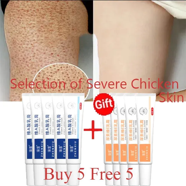 Body Whitening Cream Keratosis Pilaris Treatment Bumpy Rough Chicken Follicle Skin Repair Strawberry Legs Removal Dry Skin Care