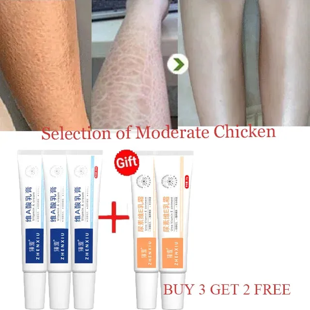 Body Whitening Cream Keratosis Pilaris Treatment Bumpy Rough Chicken Follicle Skin Repair Strawberry Legs Removal Dry Skin Care